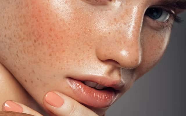 Freckles (Taches de rousseur)