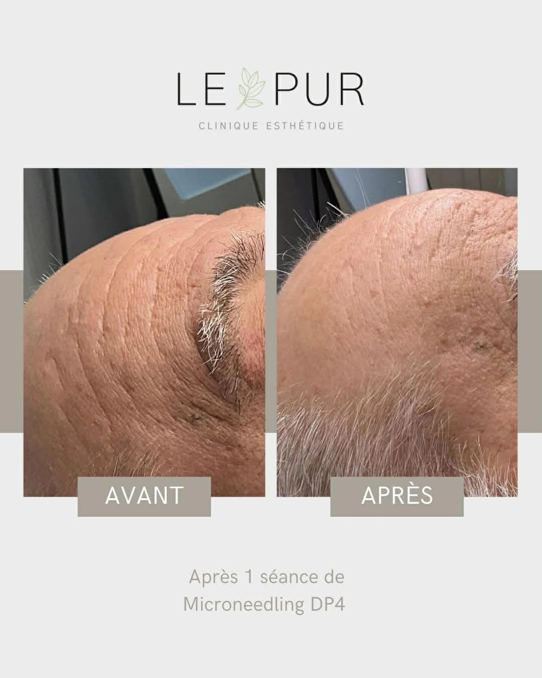 Avant/Après Microneedling DP4 - Amélioration de la texture du cuir chevelu