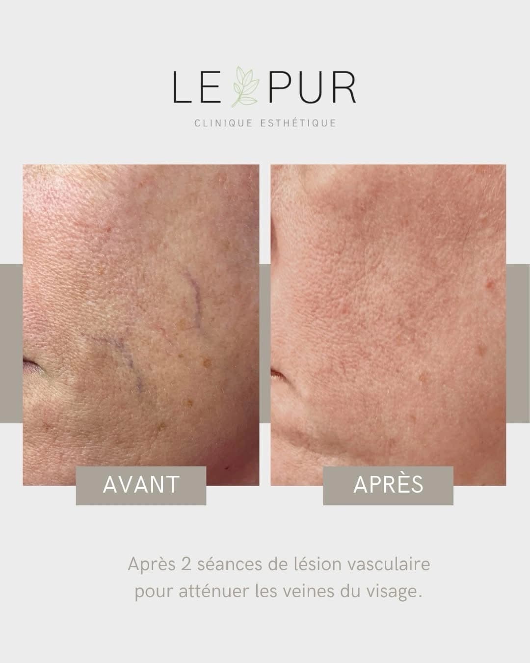 Avant/Après traitement des lésions vasculaires - Atténuation des veines du visage