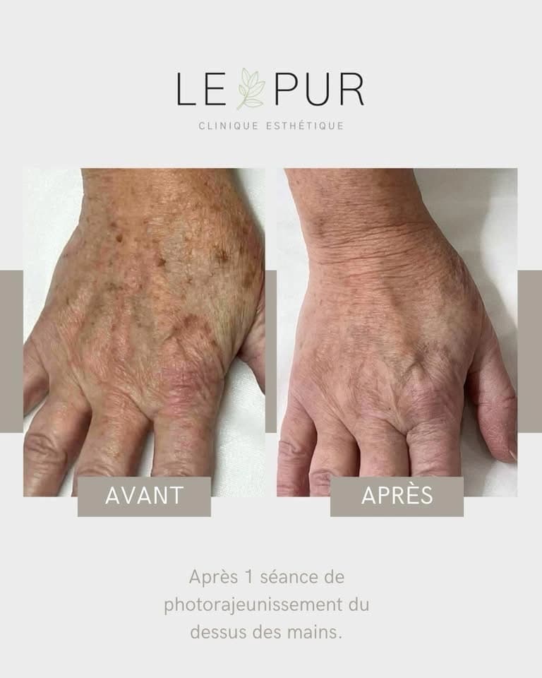 Avant/Après photorajeunissement - Traitement des mains