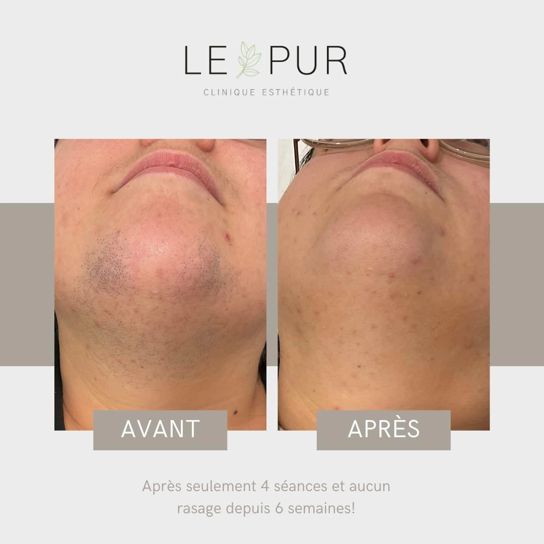 Avant/Après épilation laser du menton - 4 séances