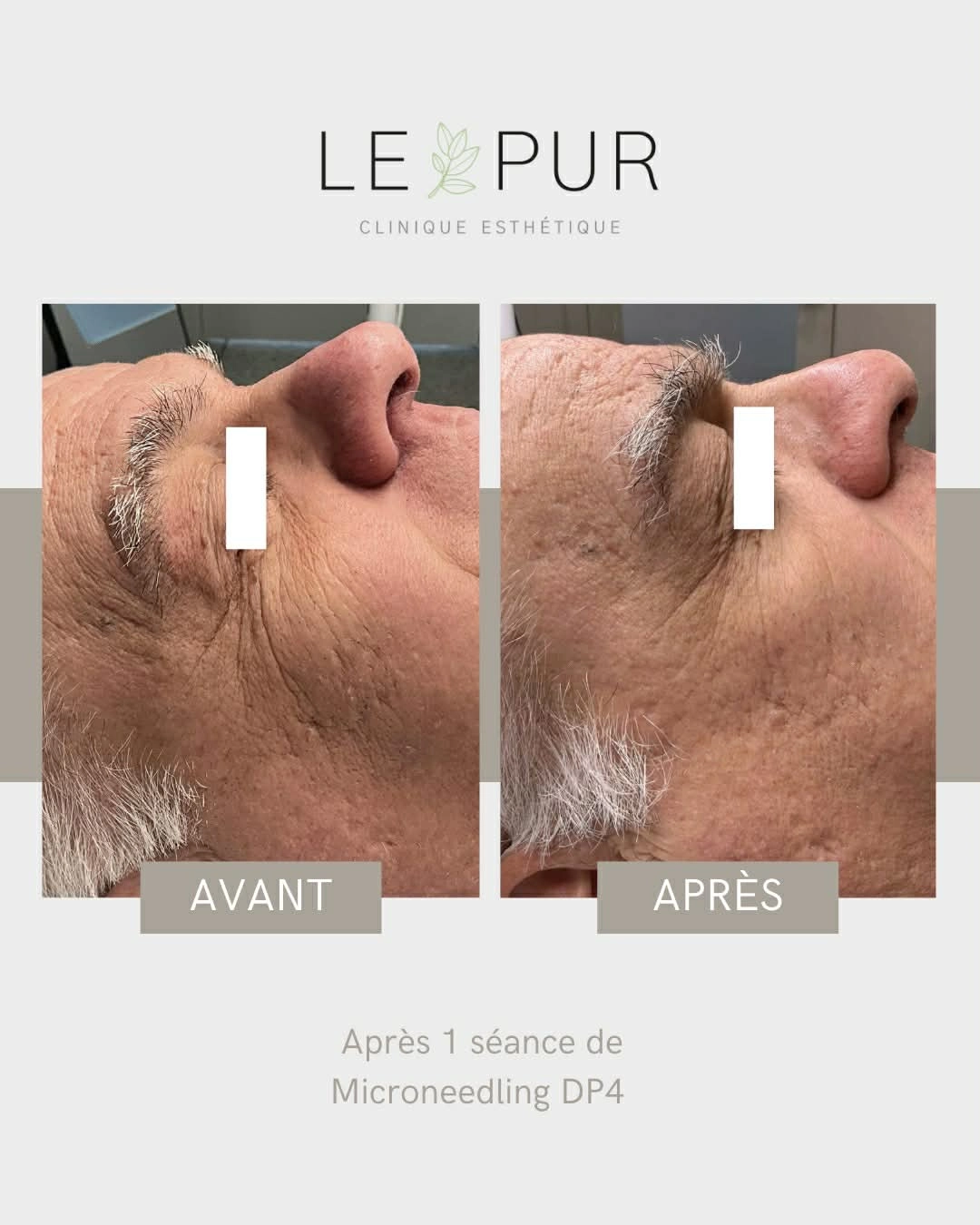 Avant/Après Microneedling DP4 - Réduction des rides du visage