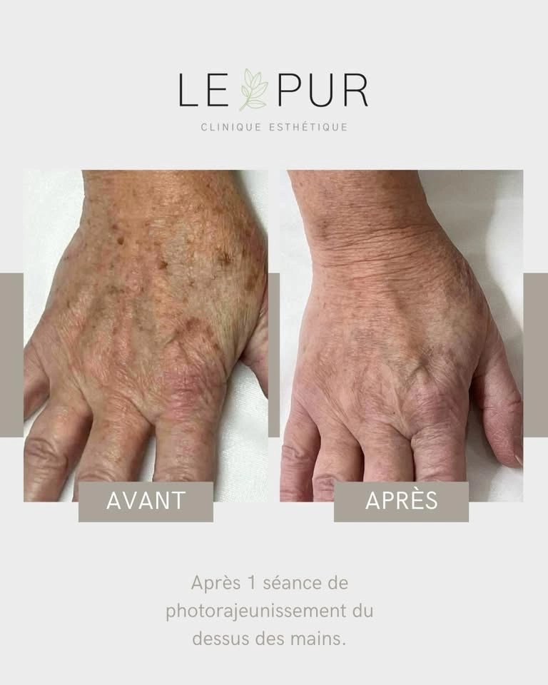 Avant/Après photorajeunissement - Traitement des mains